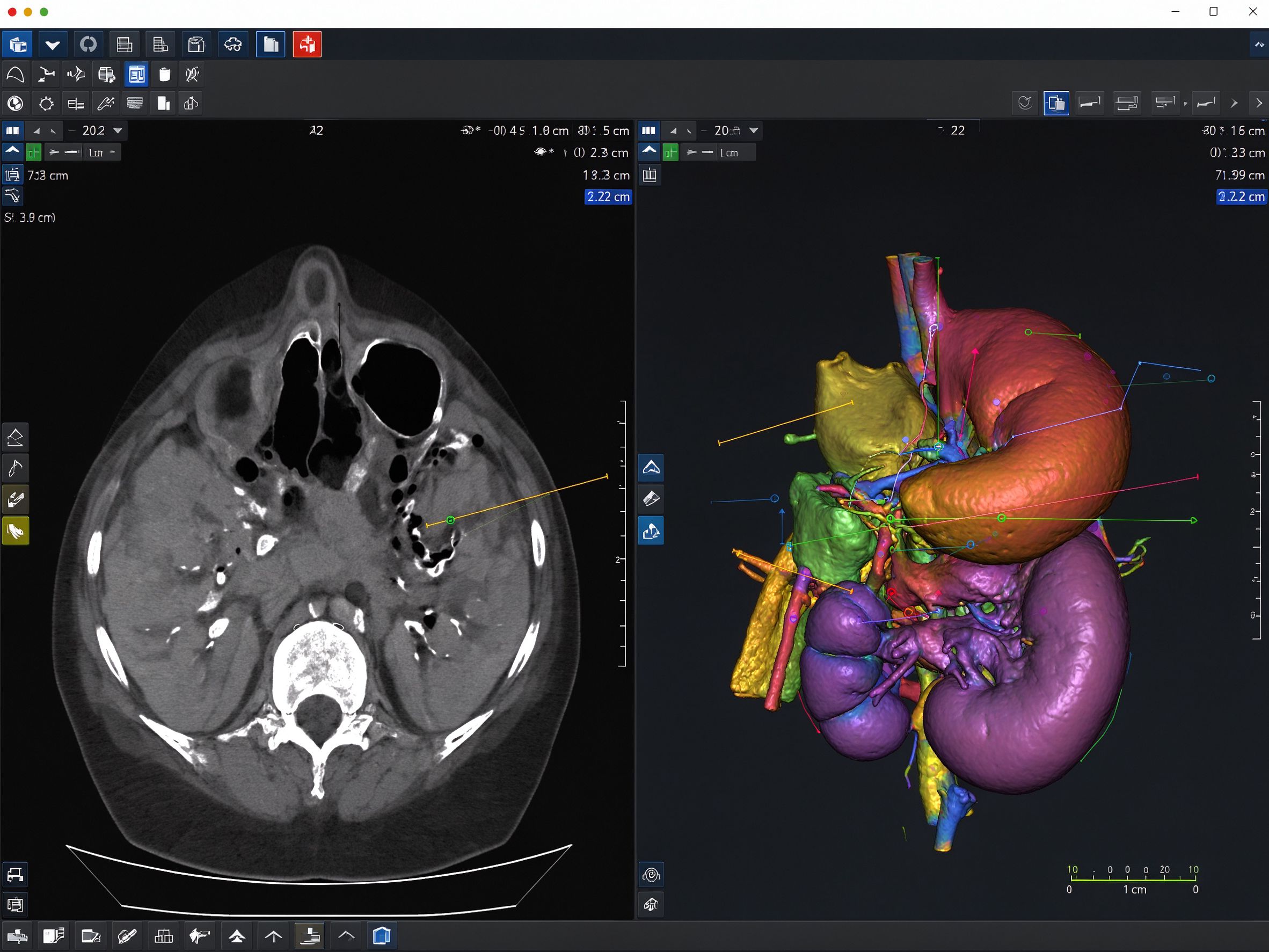 医学CT图像3D可视化分析系统